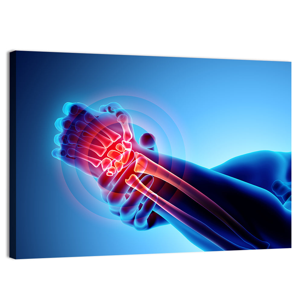 Painful Wrist X-ray Illustration Wall Art, canvas print, landscape
