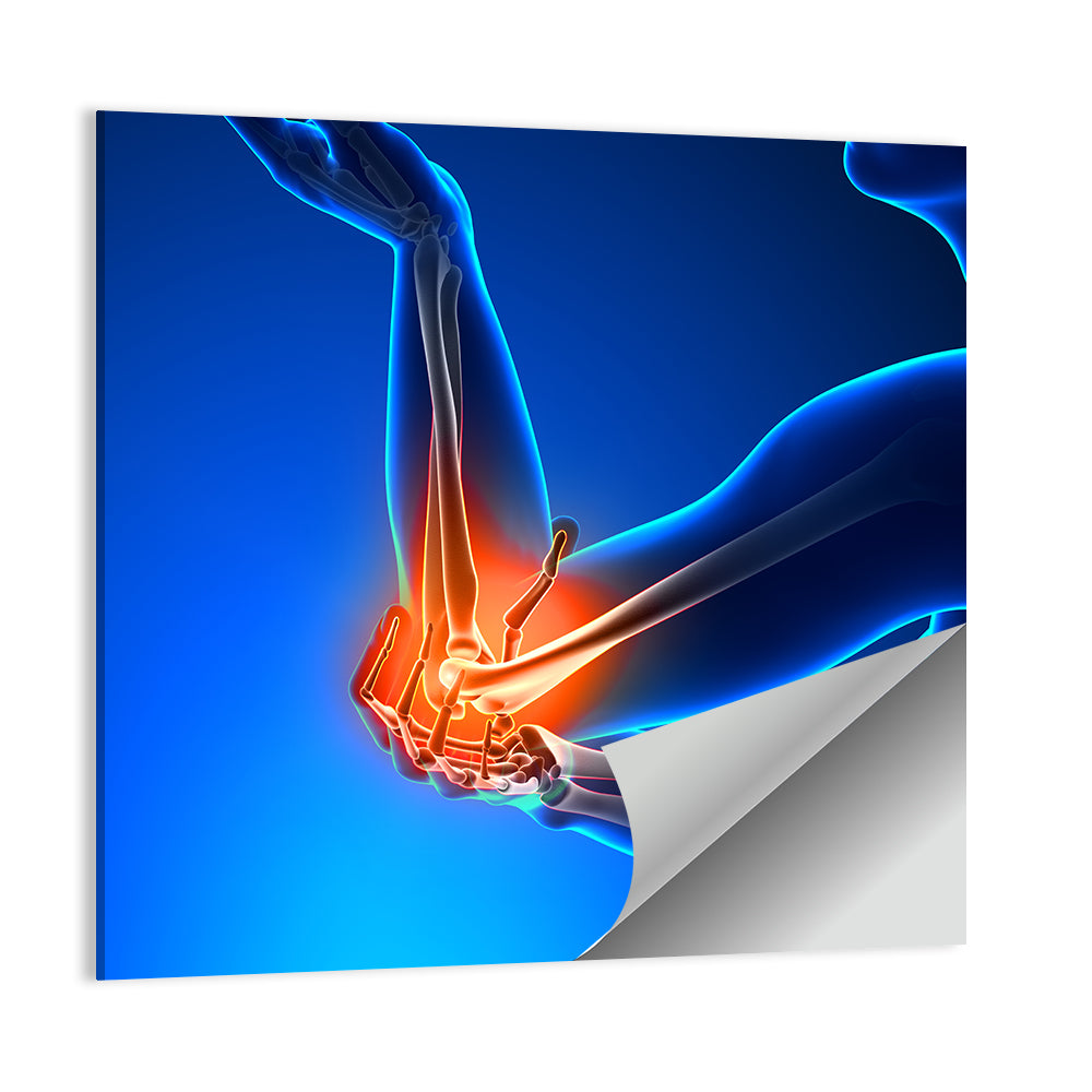 Elbow Joint Inflammation Illustration Wall Art