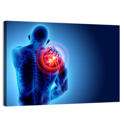 Shoulder Pain X-ray Wall Art