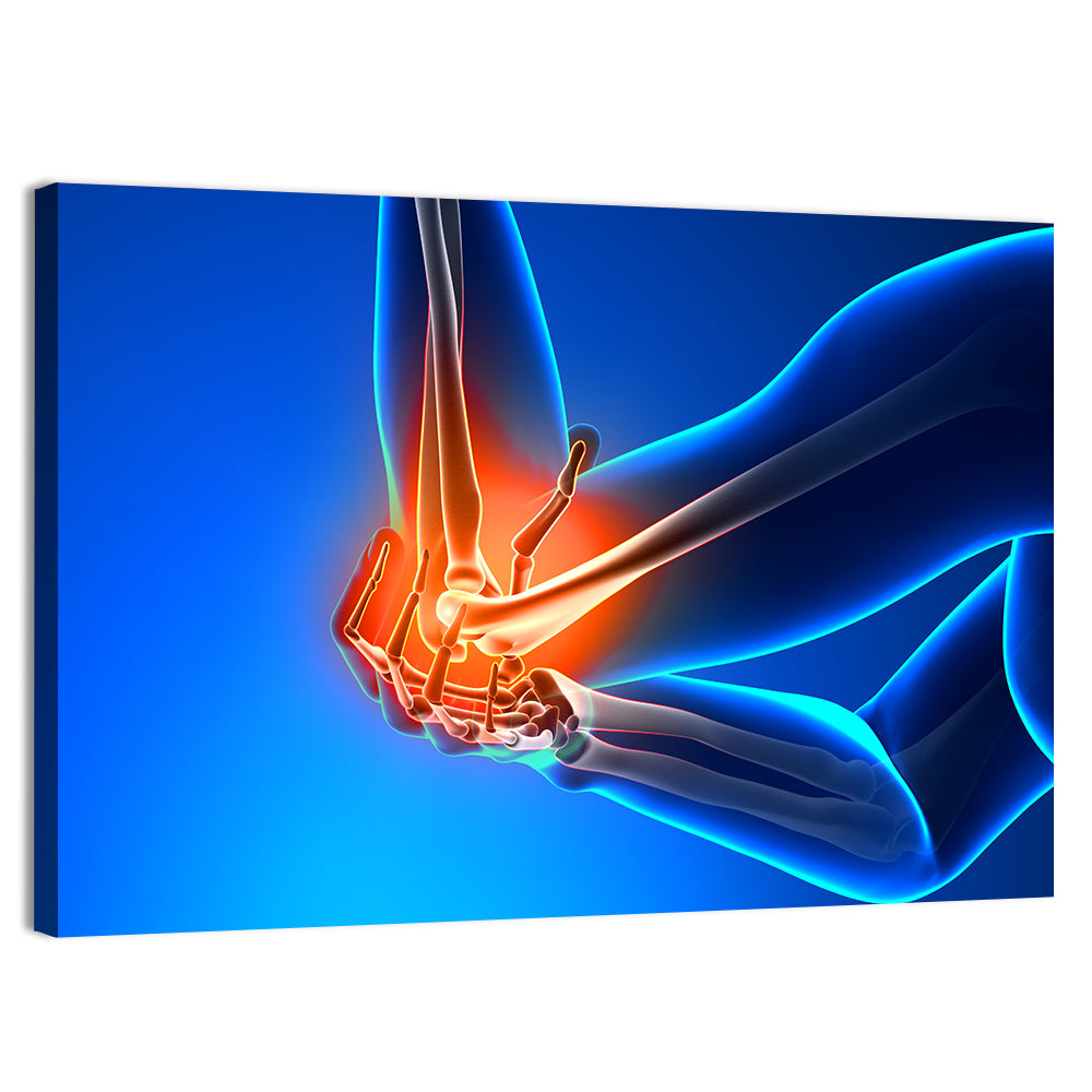 Elbow Joint Inflammation Illustration Wall Art, canvas print, landscape