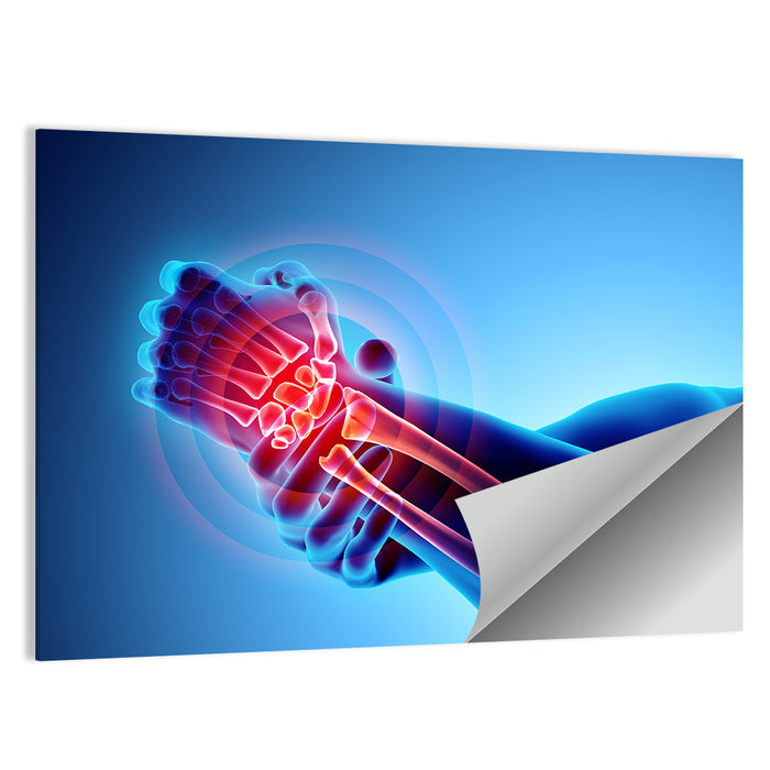 Painful Wrist X-ray Illustration Wall Art as a poster print