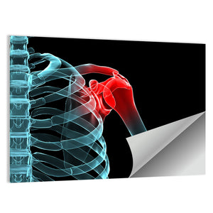 Painful Shoulder X Ray Wall Art