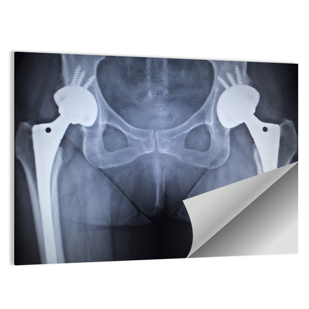 Pelvic X-ray with Hip Implants Wall Art