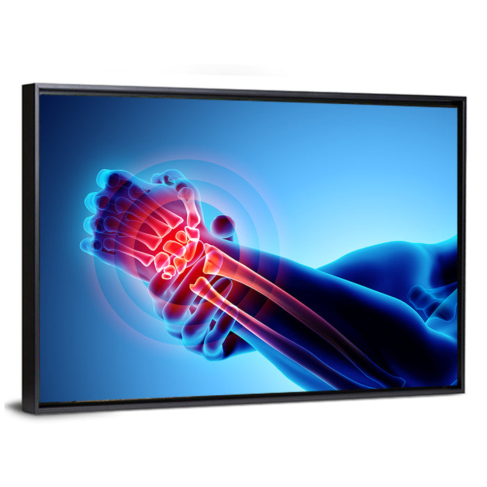 Painful Wrist X-ray Illustration Wall Art as a framed canvas