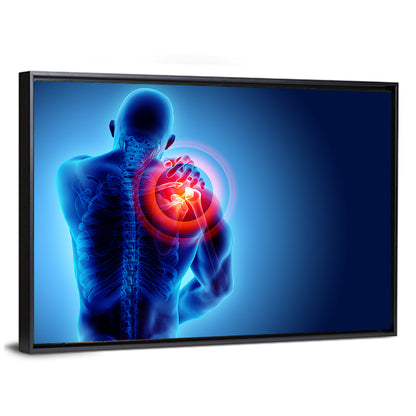 Shoulder Pain X-ray Wall Art