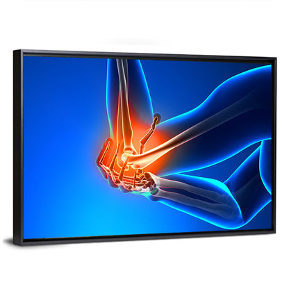 Elbow Joint Inflammation Illustration Wall Art