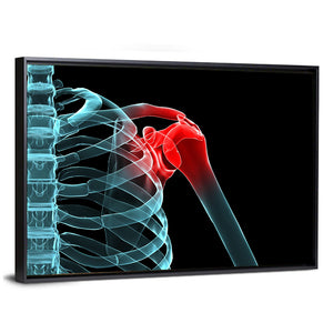 Painful Shoulder X Ray Wall Art