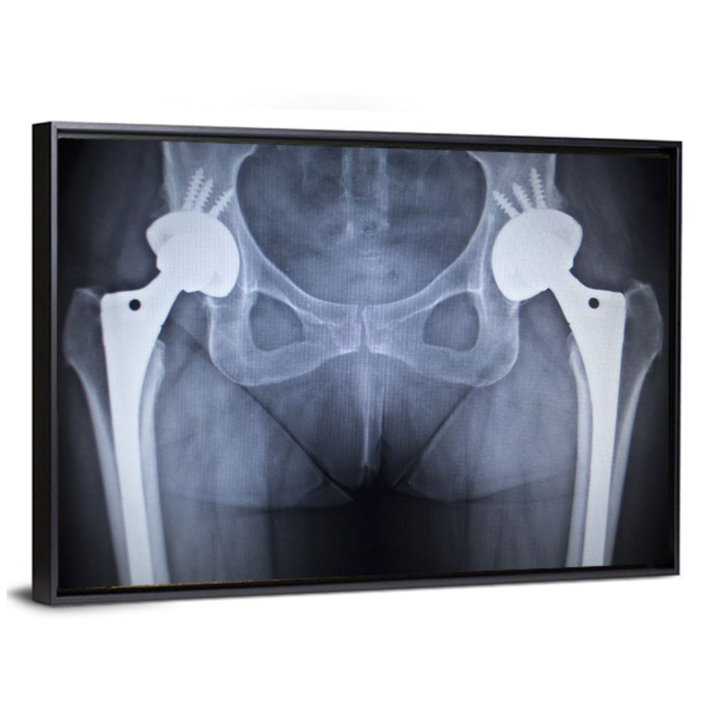 Pelvic X-ray with Hip Implants Wall Art
