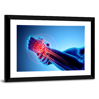 Painful Wrist X-ray Illustration Wall Art