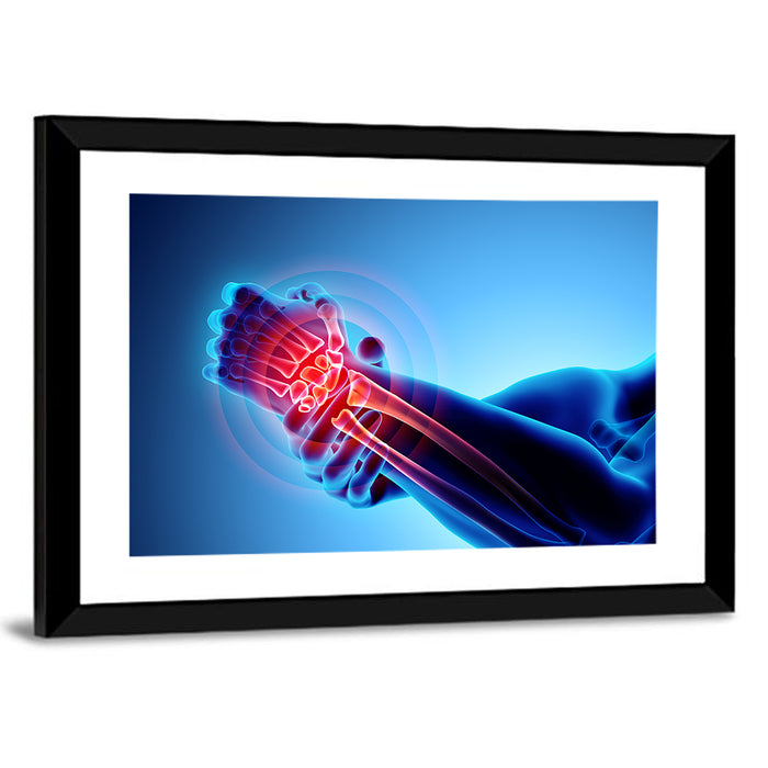 Painful Wrist X-ray Illustration Wall Art as a framed print