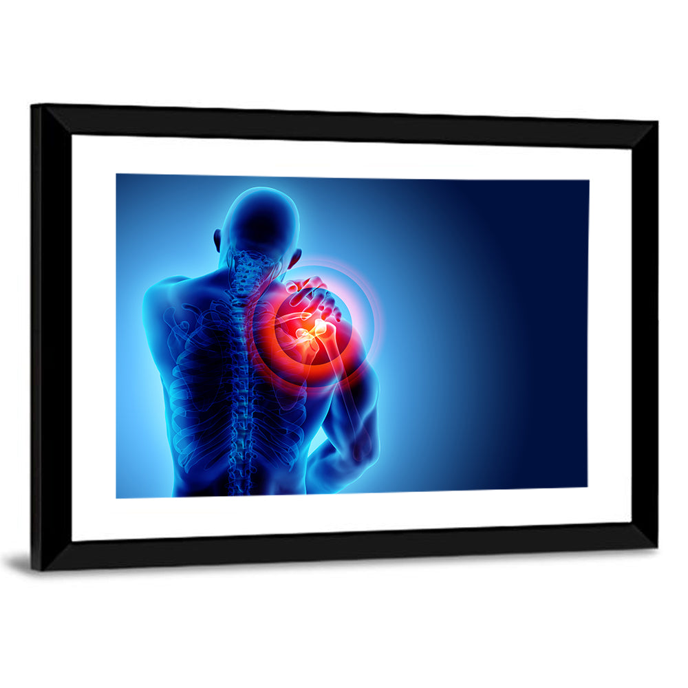 Shoulder Pain X-ray Wall Art