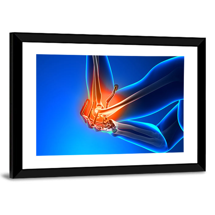 Elbow Joint Inflammation Illustration Wall Art as a framed print