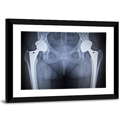 Pelvic X-ray with Hip Implants Wall Art