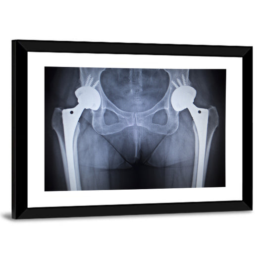 Pelvic X-ray with Hip Implants Wall Art
