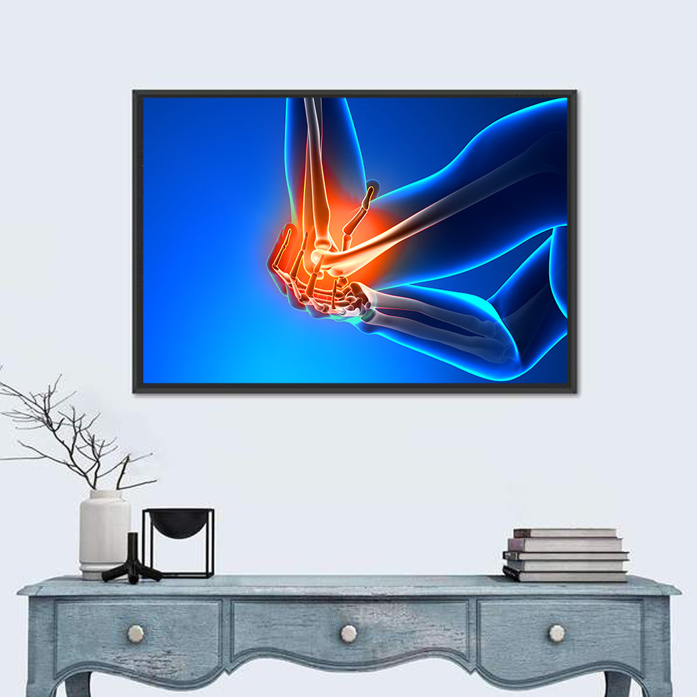 Elbow Joint Inflammation Illustration Wall Art in a room, landscape