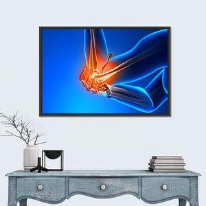 Elbow Pain Wall Art