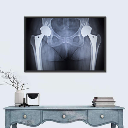 Pelvic X-ray with Hip Implants Wall Art