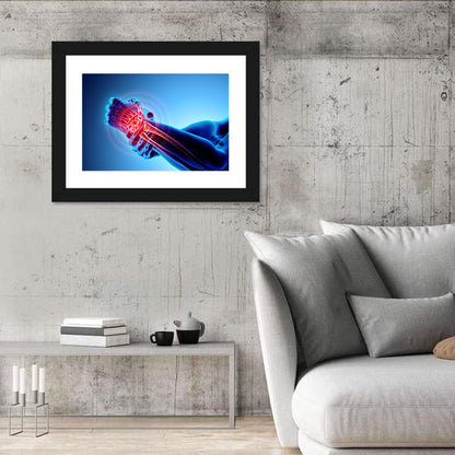 Painful Wrist X-ray Illustration Wall Art