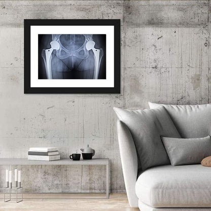 Pelvic X-ray with Hip Implants Wall Art