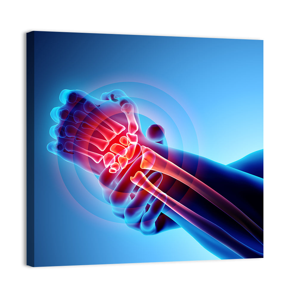 Painful Wrist X-ray Illustration Wall Art