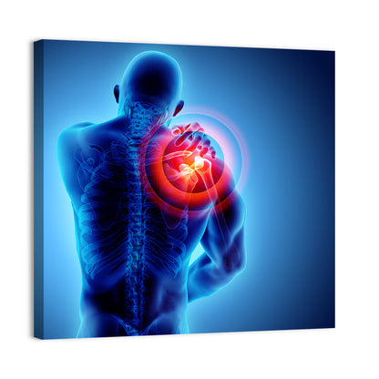 Shoulder Pain X-ray Wall Art