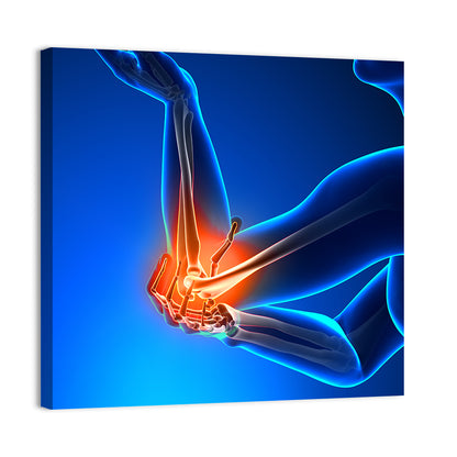 Elbow Joint Inflammation Illustration Wall Art