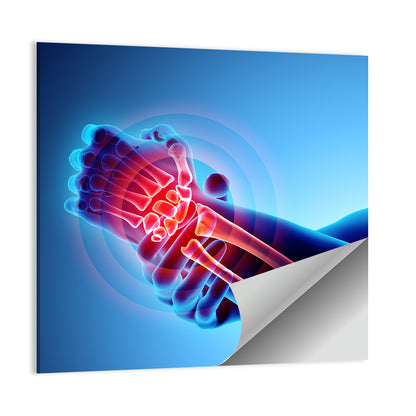 Painful Wrist X-ray Illustration Wall Art