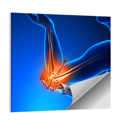 Elbow Joint Inflammation Illustration Wall Art