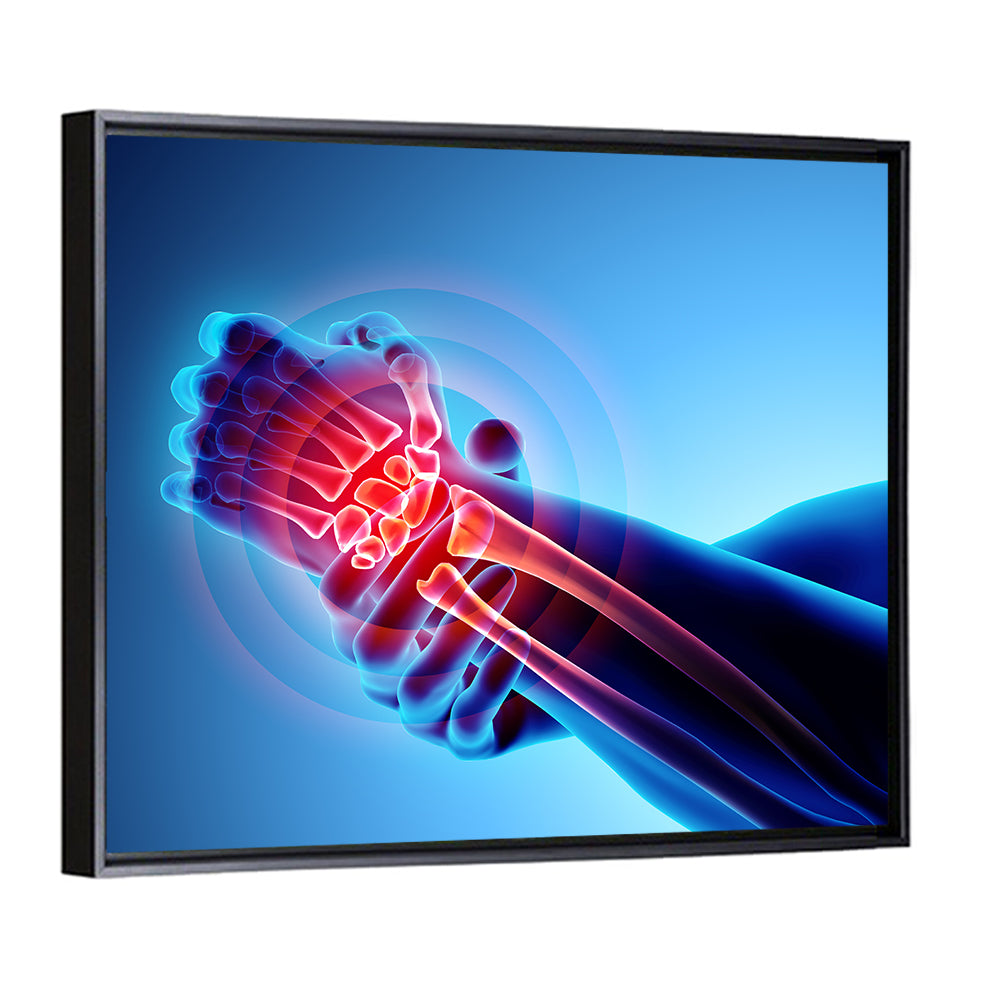 Painful Wrist X-ray Illustration Wall Art