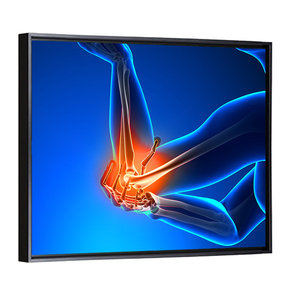 Elbow Joint Inflammation Illustration Wall Art