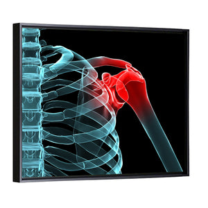 Painful Shoulder X Ray Wall Art