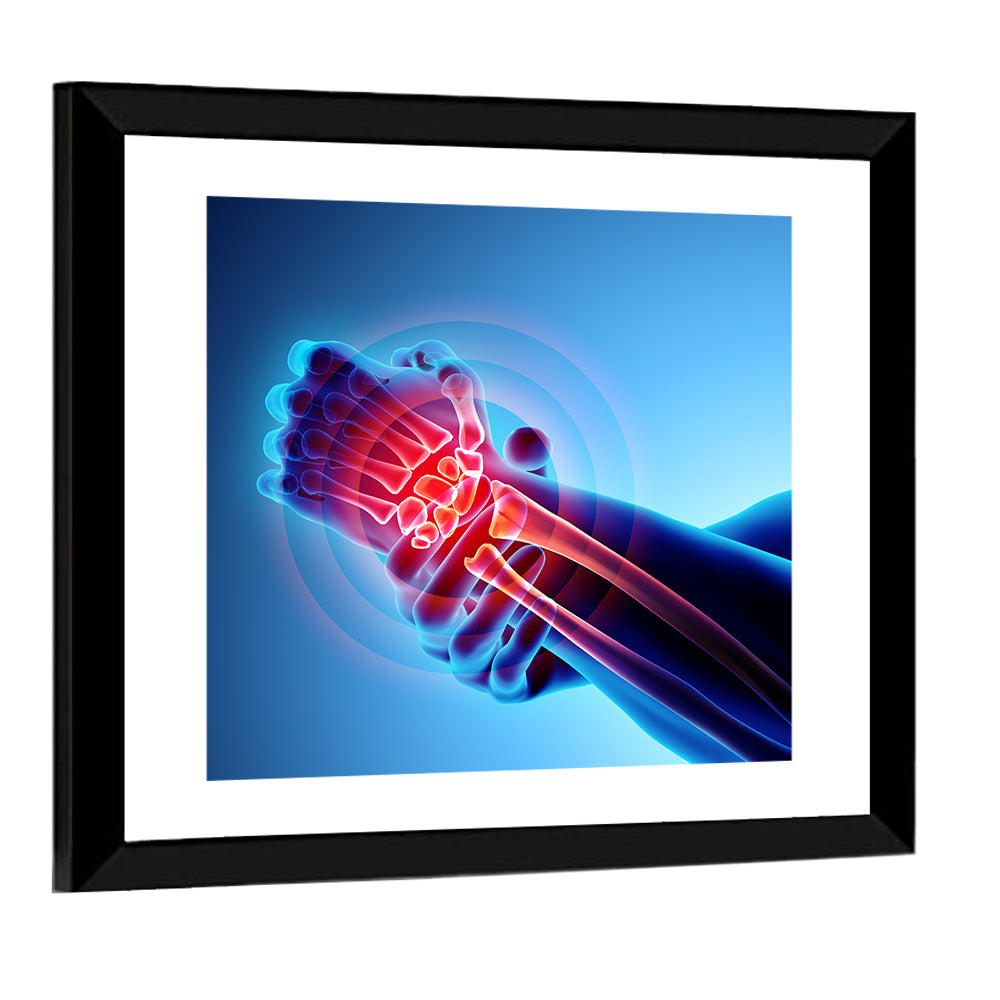 Painful Wrist X-ray Illustration Wall Art