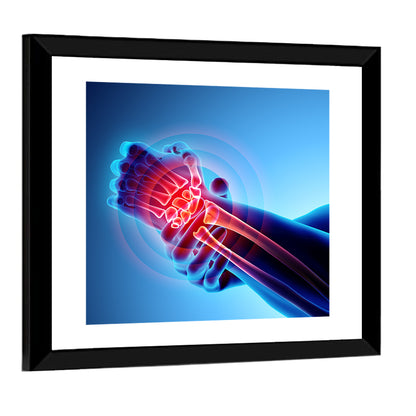 Painful Wrist X-ray Illustration Wall Art
