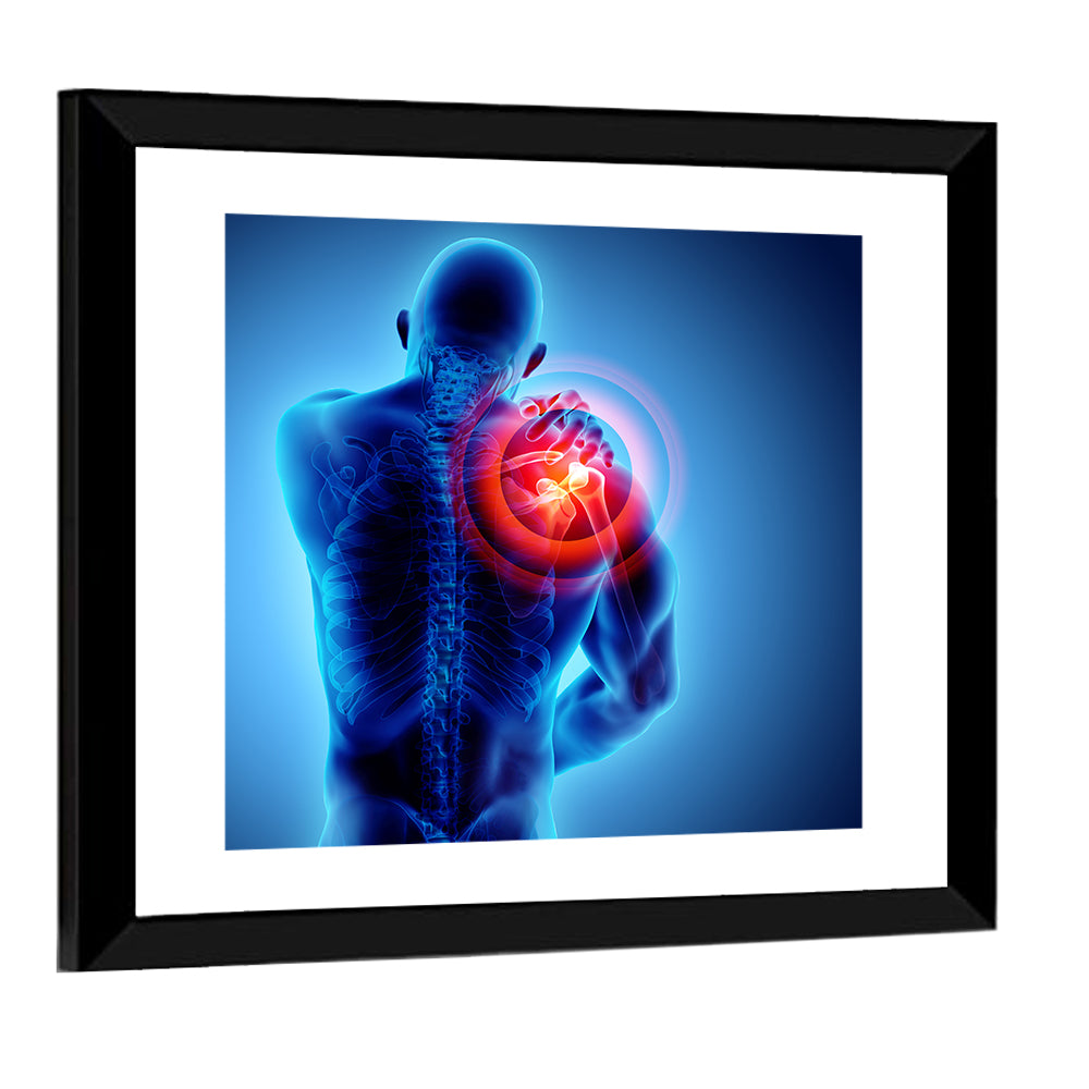 Shoulder Pain X-ray Wall Art
