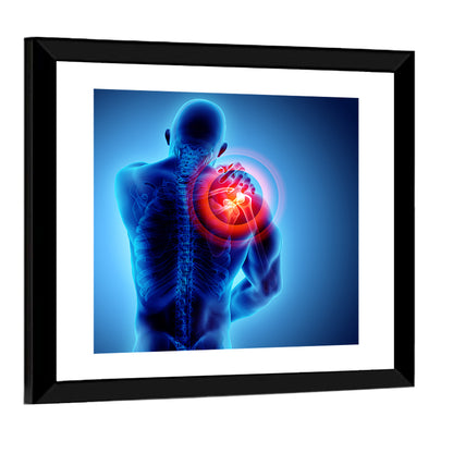 Shoulder Pain X-ray Wall Art