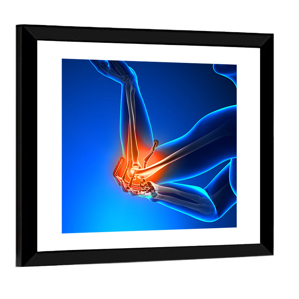 Elbow Joint Inflammation Illustration Wall Art