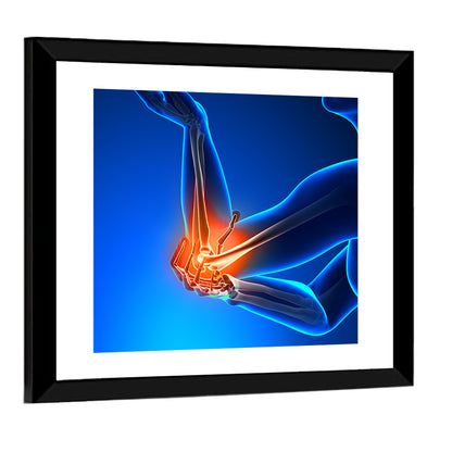 Elbow Joint Inflammation Illustration Wall Art