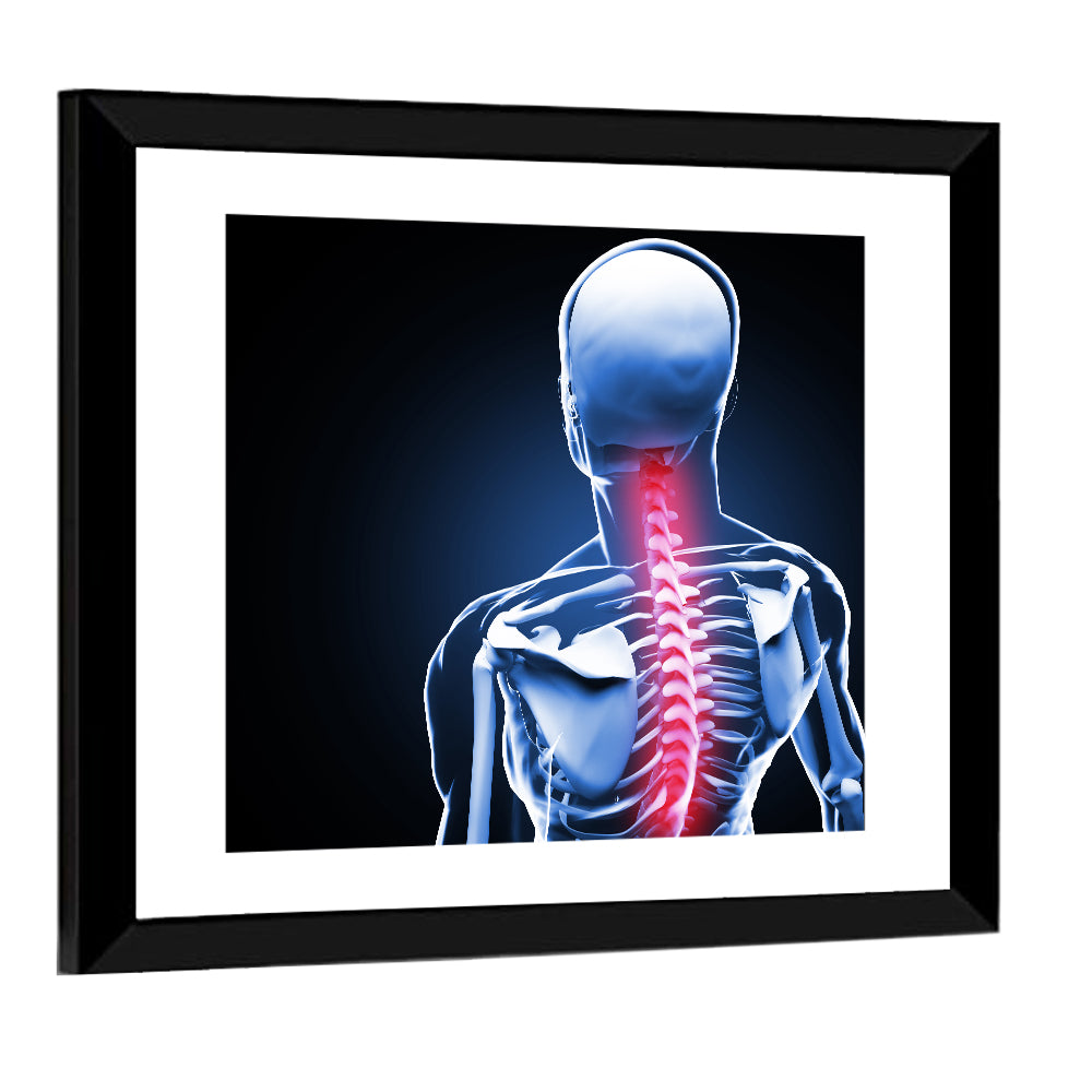 Spine Pain Anatomy Illustration Wall Art