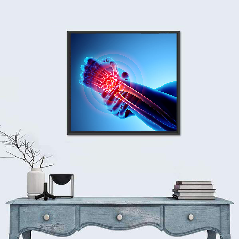 Painful Wrist X-ray Illustration Wall Art