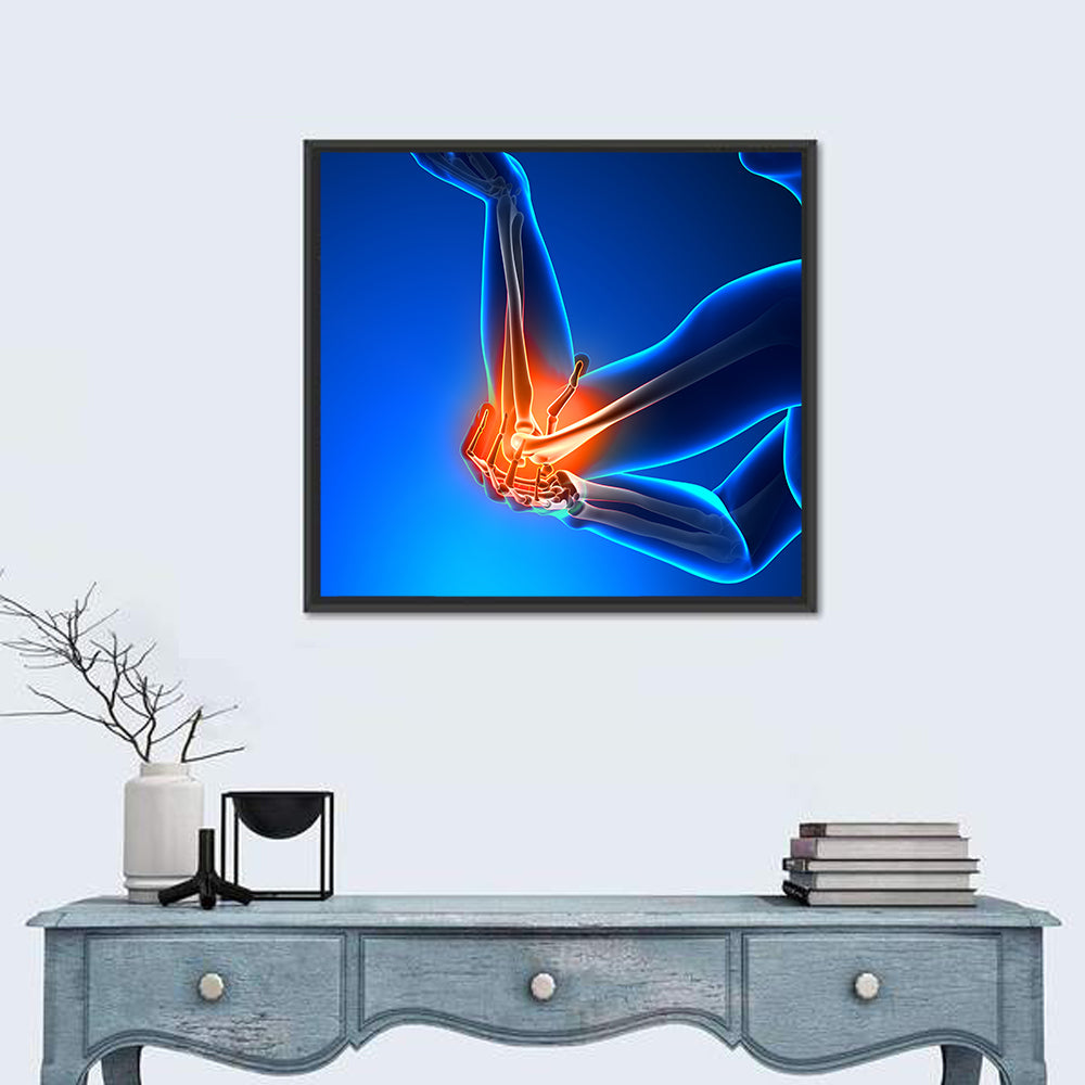 Elbow Joint Inflammation Illustration Wall Art