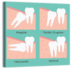 Wisdom Tooth Types Diagram Wall Art