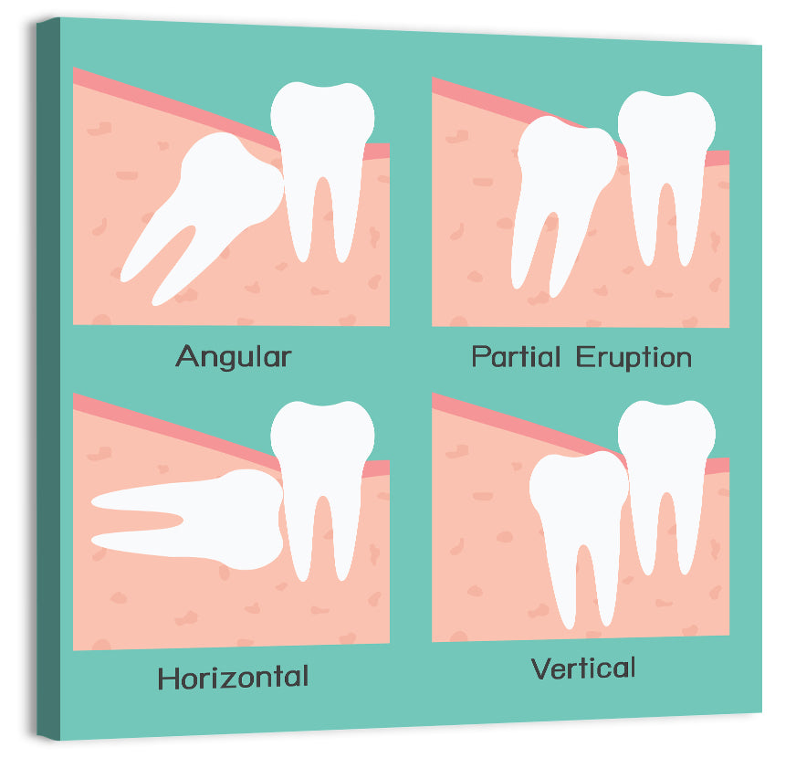 Wisdom Tooth Types Diagram Wall Art