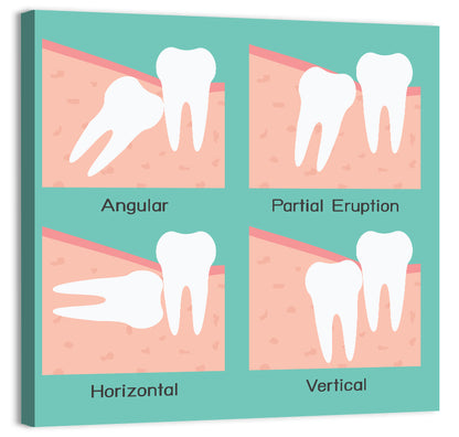 Wisdom Tooth Types Diagram Wall Art