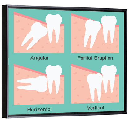 Wisdom Tooth Types Diagram Wall Art