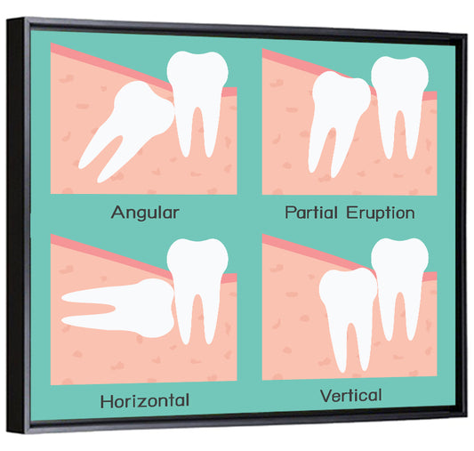 Wisdom Tooth Types Diagram Wall Art