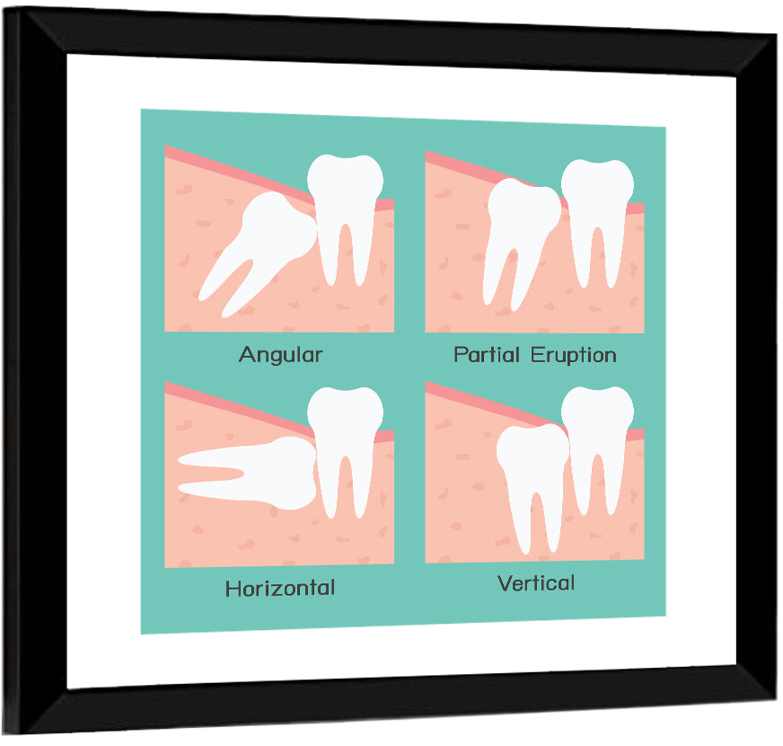 Wisdom Tooth Types Diagram Wall Art
