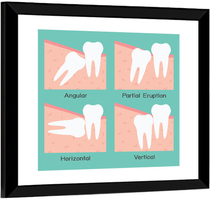 Wisdom Tooth Types Diagram Wall Art