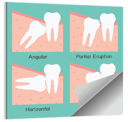 Wisdom Tooth Types Diagram Wall Art