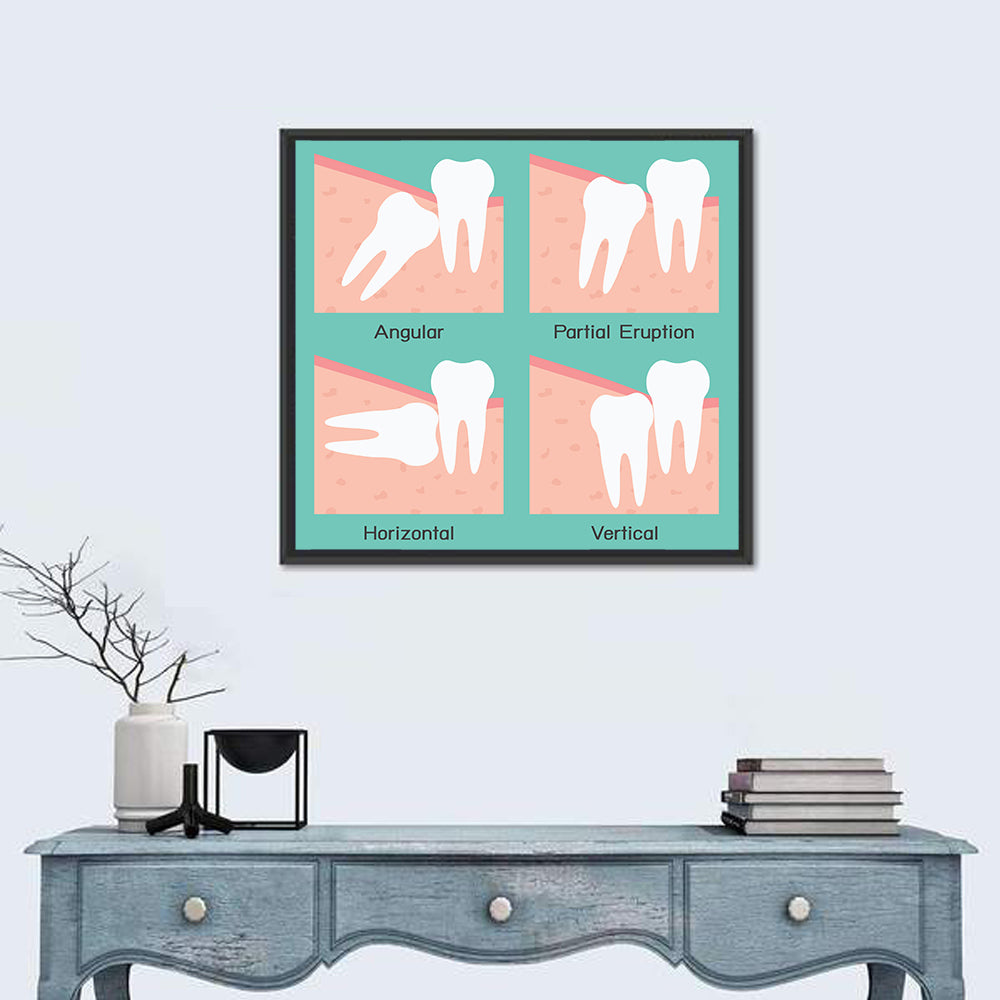 Wisdom Tooth Types Diagram Wall Art