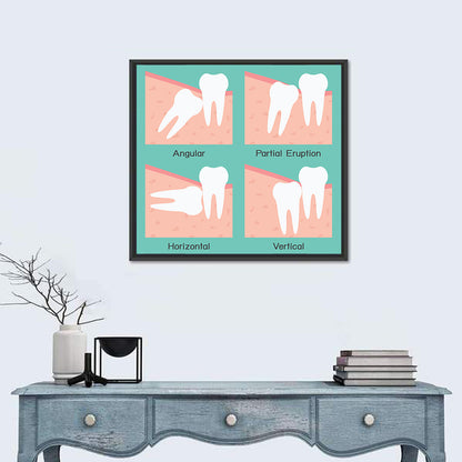 Wisdom Tooth Types Diagram Wall Art
